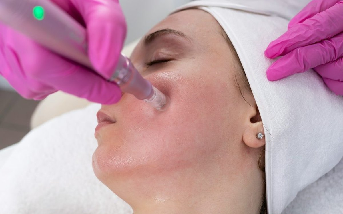 Salmon DNA και microneedling: τι είναι και γιατί γίνονται μαζί